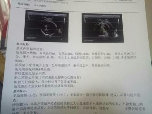 关于七个月胎儿股骨长标准的探讨