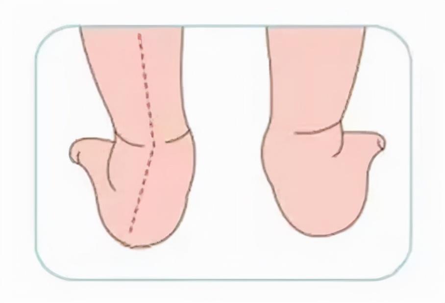 九个月宝宝的足外翻，了解、识别与应对